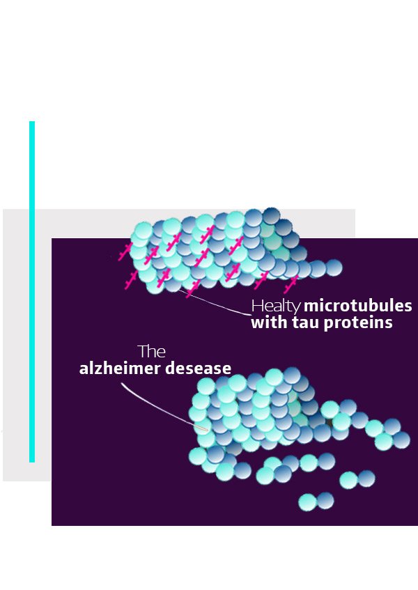 alzheimer umente